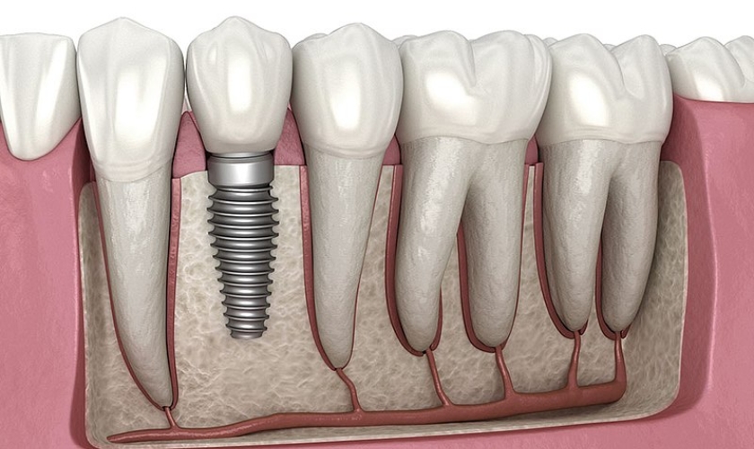 Dental Implants in Castro Valley - Castro Valley Advantage Dental