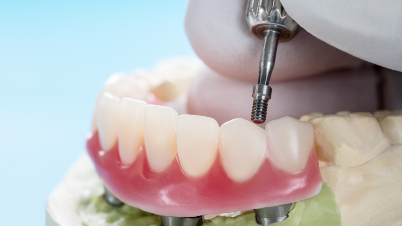 Everything You Need To Know About Full Arch Implants