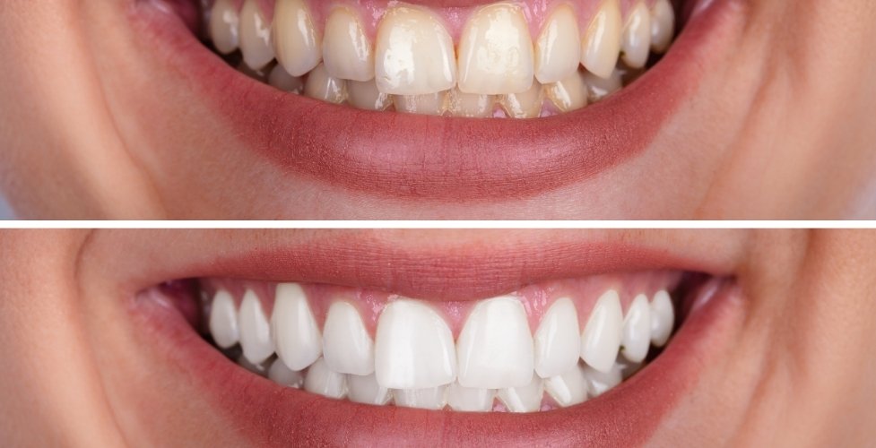 _whiten your teeth naturally