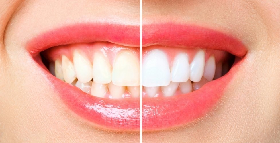 is teeth whitening painful