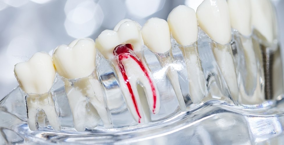 additional treatment following a root canal procedure